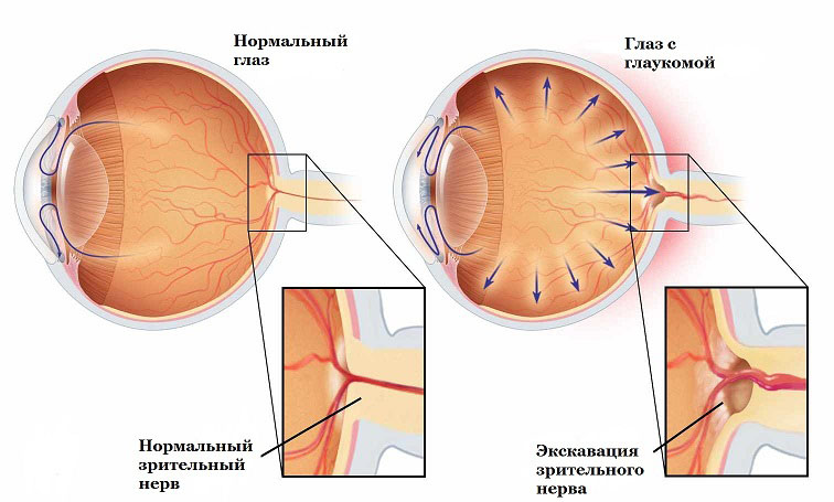 Доклад по теме Сосудистые факторы риска развития глаукомы с нормальным давлением